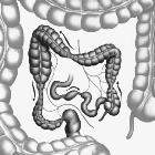 Older ‘overlooked’ treatments best options for IBS